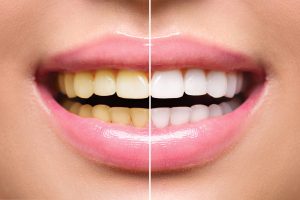 Read more about the article The Ruling Science Behind The Teeth Whitening