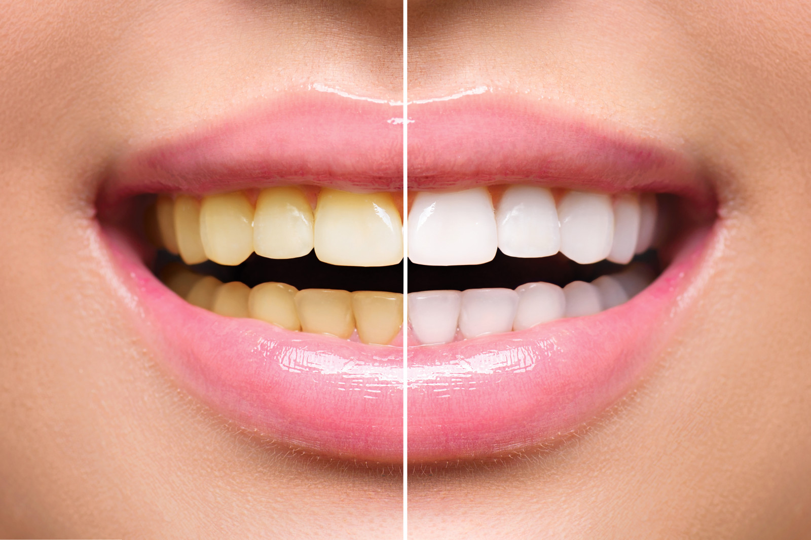 You are currently viewing The Ruling Science Behind The Teeth Whitening