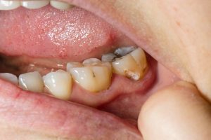 Read more about the article Tooth Cavities