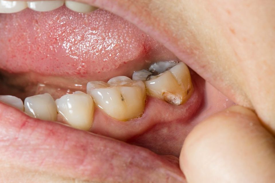 You are currently viewing Tooth Cavities
