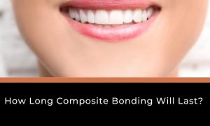 Read more about the article How Long Composite Bonding Will Last in Your Teeth?