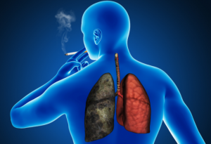 Read more about the article Lung Cancer Origin in Non-Smokers: Experts Opinion