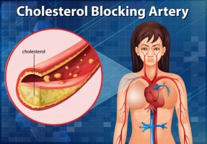 Read more about the article How To Choose Medications That Lower Cholesterol
