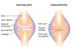 Read more about the article Knee Joint Replacement with Minimally Invasive Surgery (MIS)