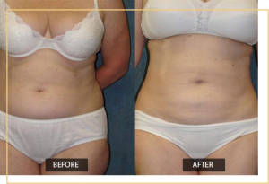 Read more about the article Does Fat Return After Liposuction?