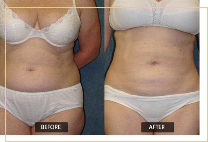 Read more about the article Does Fat Return After Liposuction?
